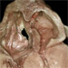 Mitral Hypoplasia